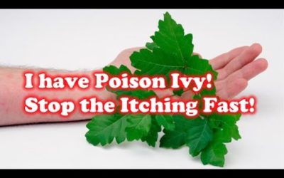 I have Poison Ivy! How to Stop the Itching Fast!